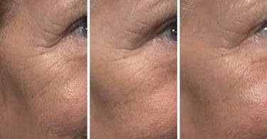 Stronger Is Not Always Better: Why Progressive Skin Treatment Matters